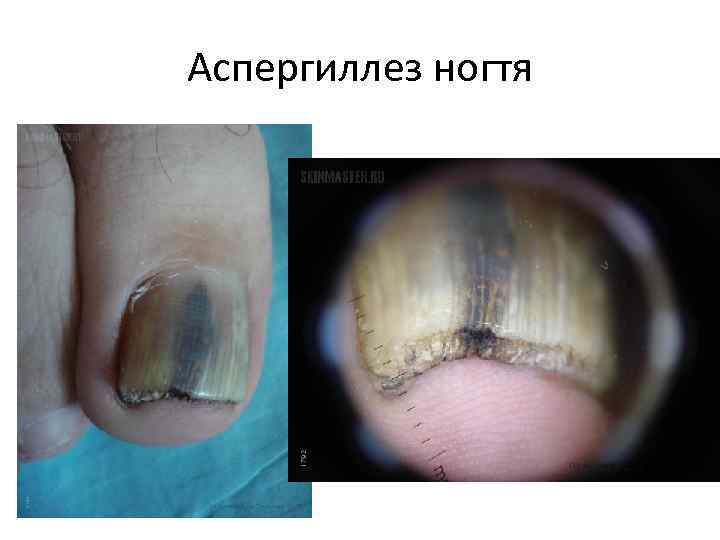 Аспергиллез ногтя 