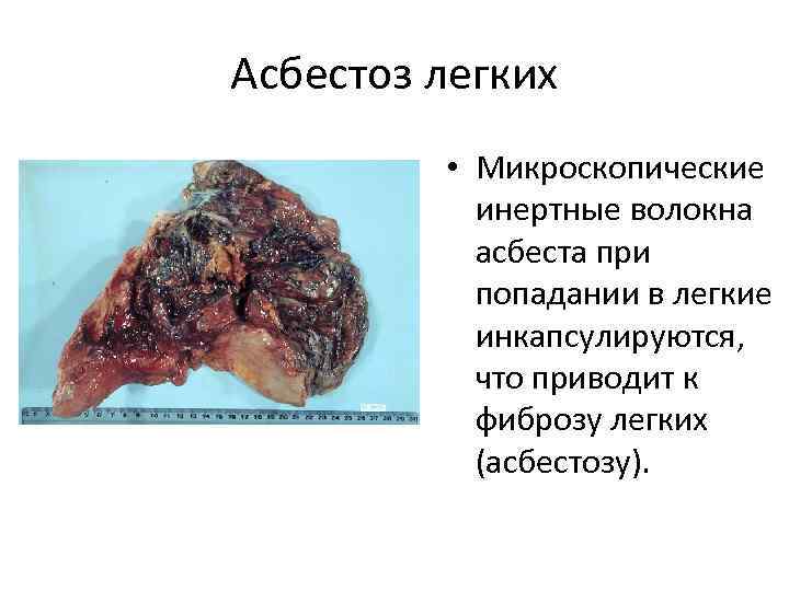 Асбестоз легких • Микроскопические инертные волокна асбеста при попадании в легкие инкапсулируются, что приводит