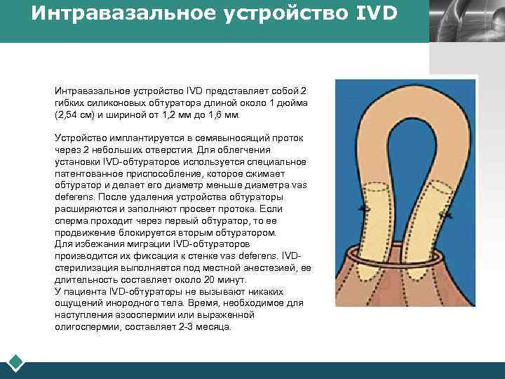 Интравазальное устройство IVD представляет собой 2 гибких силиконовых обтуратора длиной около 1 дюйма (2,