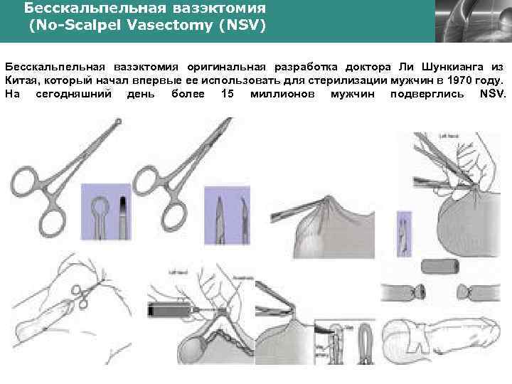 Вазэктомия что это. Хирургическая стерилизация вазэктомия. Бесскальпельная вазэктомия. Вазэктомия (вазорезекция). Вазэктомия схема операции.