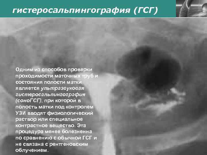 гистеросальпингография (ГСГ) Одним из способов проверки проходимости маточных труб и состояния полости матки является