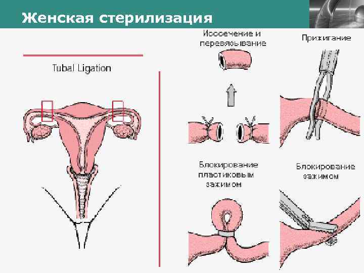 Женская стерилизация LOGO 