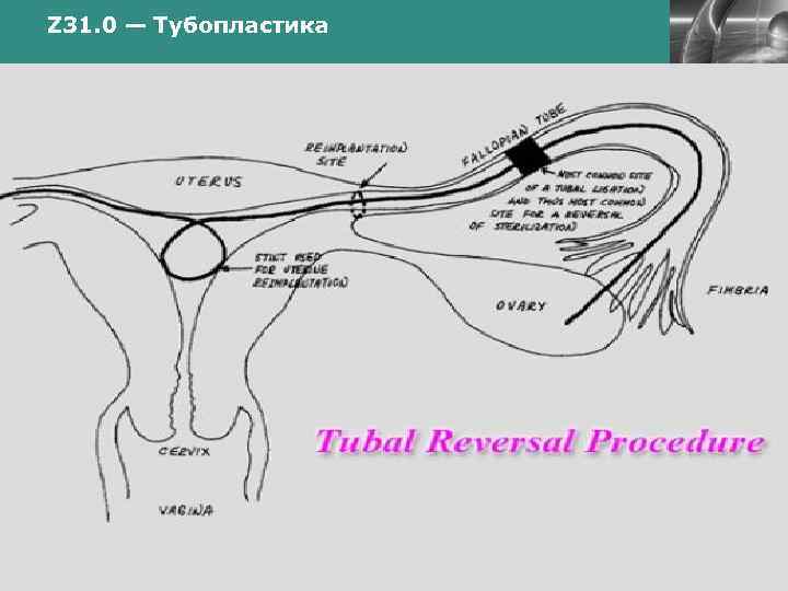 Z 31. 0 — Тубопластика www. themegallery. com LOGO Company Logo 