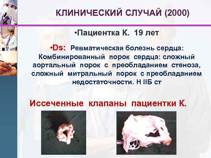 КЛИНИЧЕСКИЙ СЛУЧАЙ (2000) • Пациентка К. 19 лет • Ds: Ревматическая болезнь сердца: Комбинированный