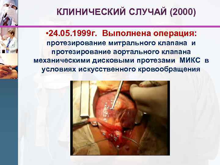 КЛИНИЧЕСКИЙ СЛУЧАЙ (2000) • 24. 05. 1999 г. Выполнена операция: протезирование митрального клапана и