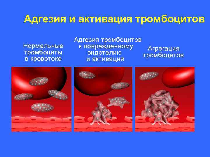 Адгезия и активация тромбоцитов Нормальные тромбоциты в кровотоке Адгезия тромбоцитов к поврежденному Агрегация эндотелию