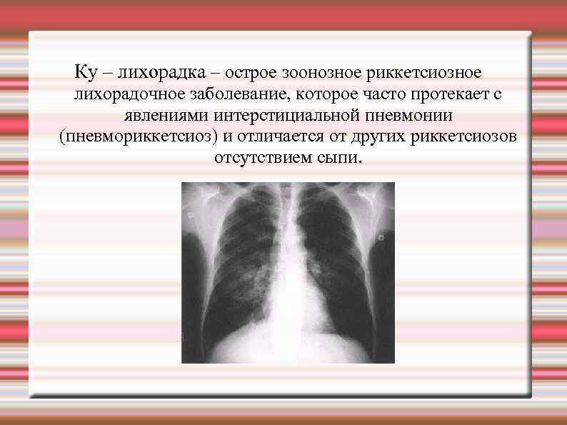 Ку – лихорадка – острое зоонозное риккетсиозное лихорадочное заболевание, которое часто протекает с явлениями