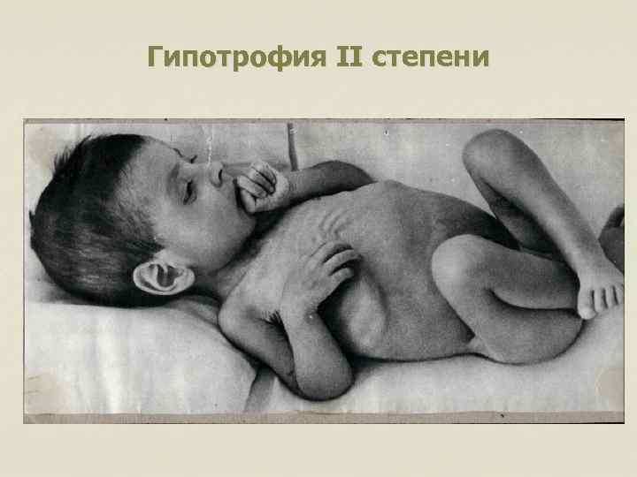 Гипотрофия II степени 