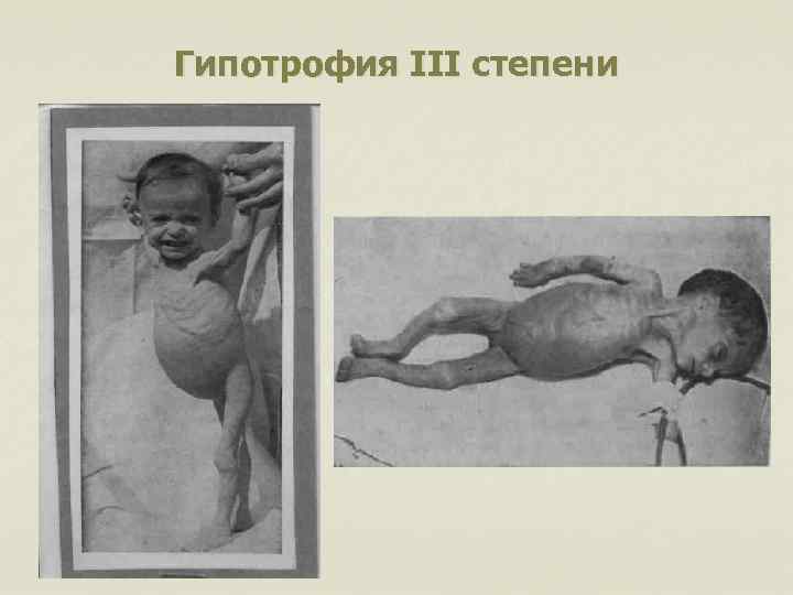 Гипотрофия III степени 