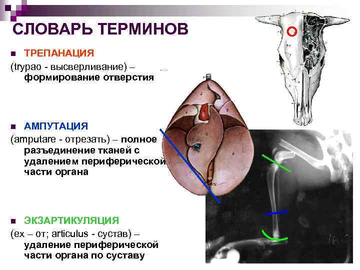СЛОВАРЬ ТЕРМИНОВ ТРЕПАНАЦИЯ (trypao - высверливание) – формирование отверстия n АМПУТАЦИЯ (amputare - отрезать)