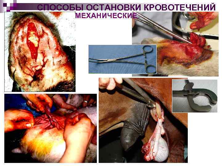 СПОСОБЫ ОСТАНОВКИ КРОВОТЕЧЕНИЙ МЕХАНИЧЕСКИЕ 