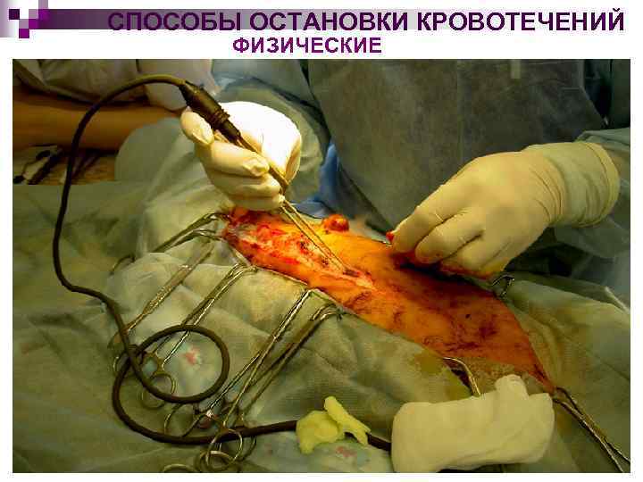 СПОСОБЫ ОСТАНОВКИ КРОВОТЕЧЕНИЙ ФИЗИЧЕСКИЕ 