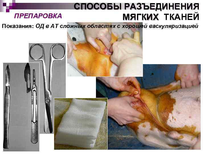ПРЕПАРОВКА СПОСОБЫ РАЗЪЕДИНЕНИЯ МЯГКИХ ТКАНЕЙ Показания: ОД в АТ сложных областях с хорошей васкуляризацией