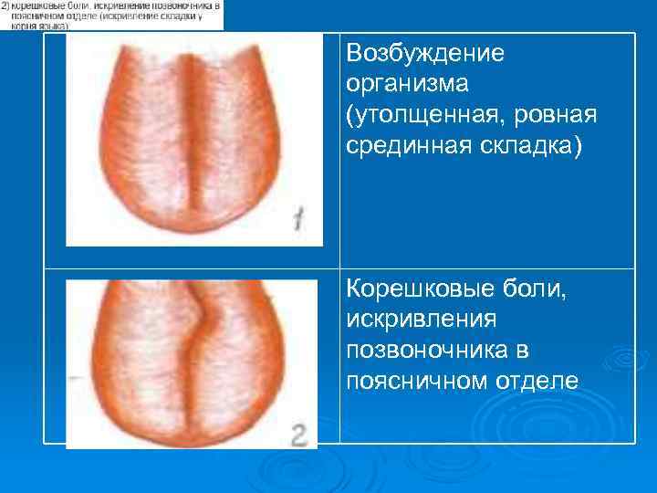 Возбуждение организма (утолщенная, ровная срединная складка) Корешковые боли, искривления позвоночника в поясничном отделе 