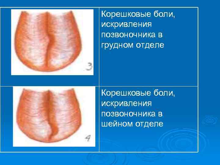 Корешковые боли, искривления позвоночника в грудном отделе Корешковые боли, искривления позвоночника в шейном отделе
