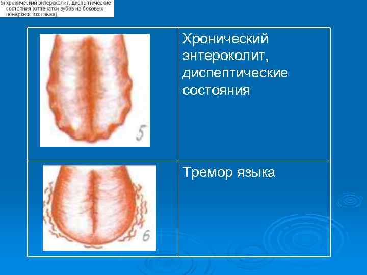 Хронический энтероколит, диспептические состояния Тремор языка 