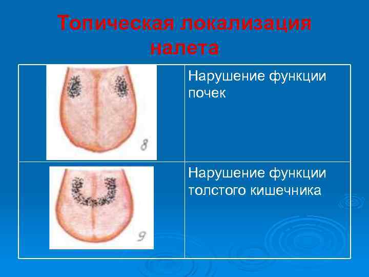 Топическая локализация налета Нарушение функции почек Нарушение функции толстого кишечника 