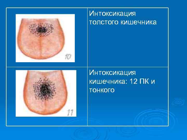 Интоксикация толстого кишечника Интоксикация кишечника: 12 ПК и тонкого 
