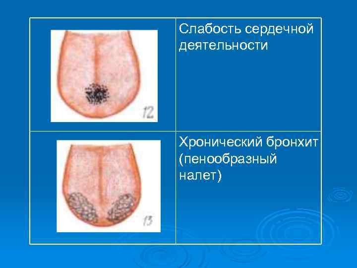 Слабость сердечной деятельности Хронический бронхит (пенообразный налет) 