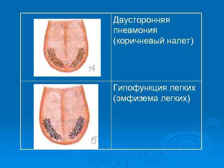 Двусторонняя пневмония (коричневый налет) Гипофункция легких (эмфизема легких) 
