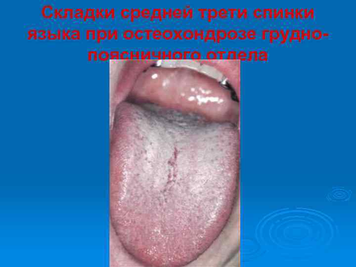 Складки средней трети спинки языка при остеохондрозе груднопоясничного отдела 