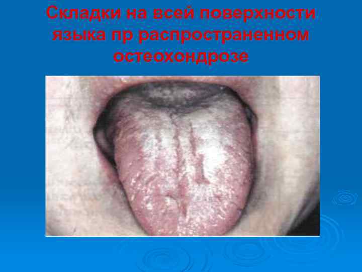 Складки на всей поверхности языка пр распространенном остеохондрозе 