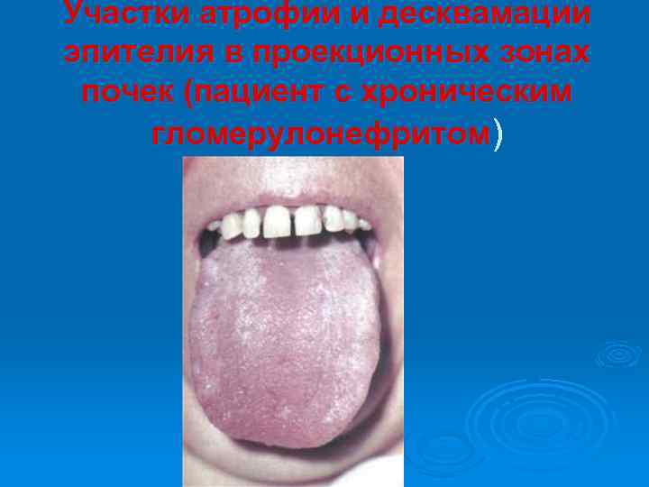 Участки атрофии и десквамации эпителия в проекционных зонах почек (пациент с хроническим гломерулонефритом) 