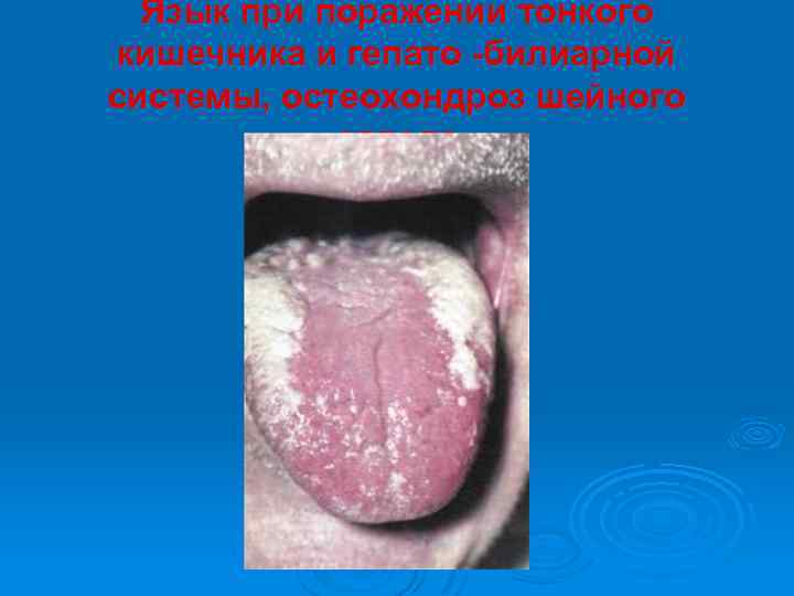 Язык при поражении тонкого кишечника и гепато -билиарной системы, остеохондроз шейного отдела 