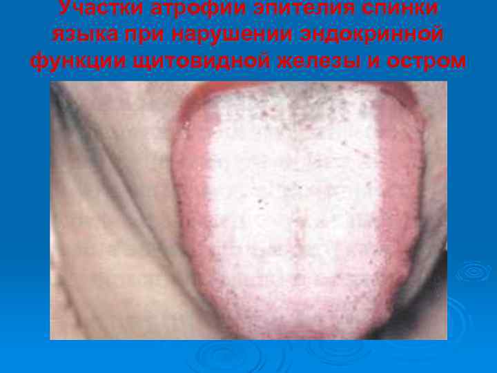 Участки атрофии эпителия спинки языка при нарушении эндокринной функции щитовидной железы и остром гастрите