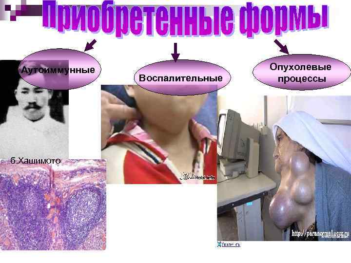 Аутоиммунные б. Хашимото Воспалительные Опухолевые процессы 