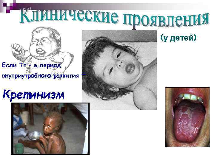 (у детей) Если Тг – в период внутриутробного развития Кретинизм – 