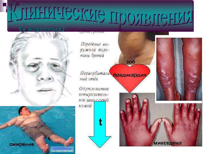 (у взрослых) зоб брадикардия t ожирение микседема 