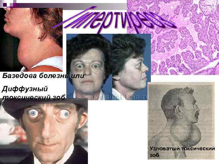 Базедова болезнь или Диффузный токсический зоб Узловатый токсический зоб 
