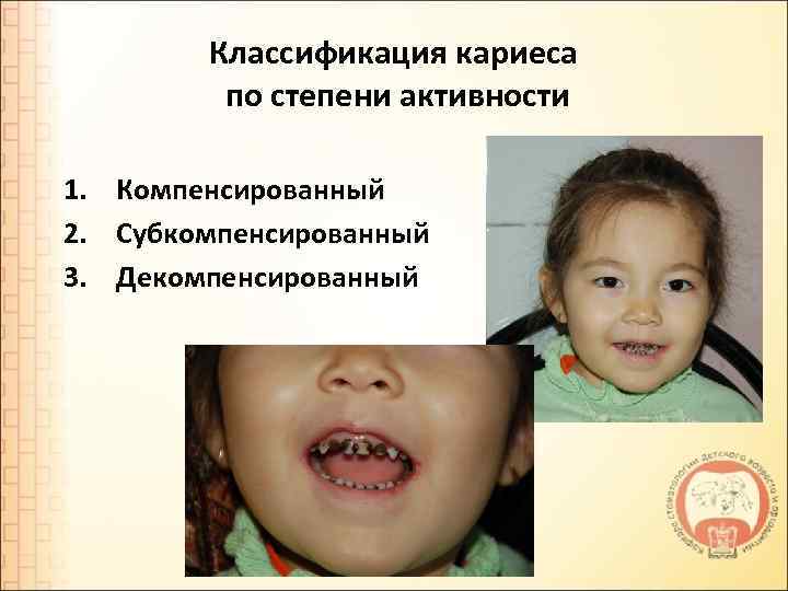 Классификация кариеса по степени активности 1. Компенсированный 2. Субкомпенсированный 3. Декомпенсированный 