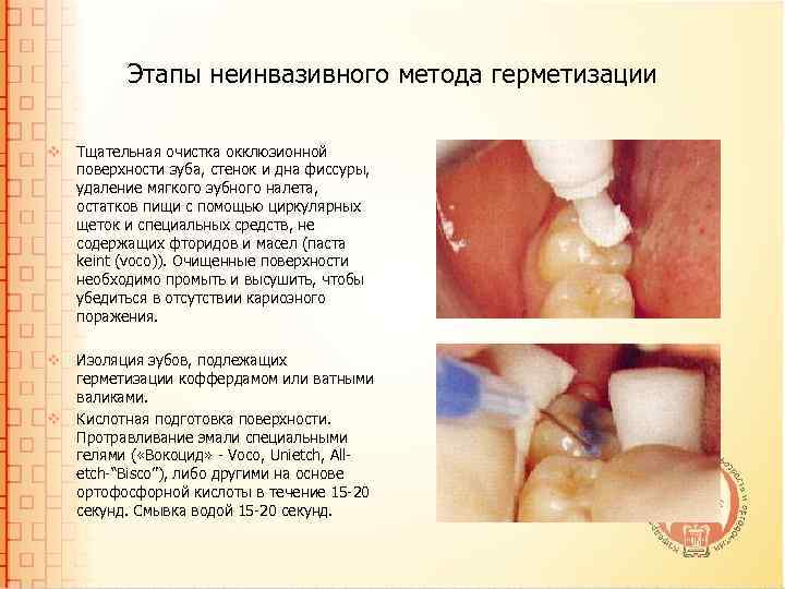 Этапы неинвазивного метода герметизации v Тщательная очистка окклюзионной поверхности зуба, стенок и дна фиссуры,