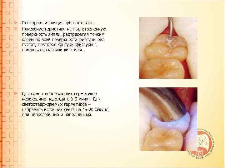 v Повторная изоляция зуба от слюны. v Нанесение герметика на подготовленную поверхность эмали, распределяя