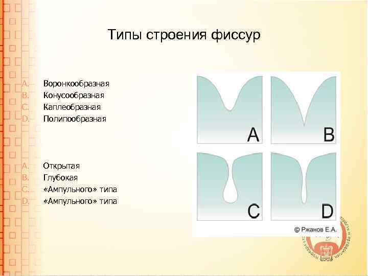 Типы строения фиссур A. B. C. D. Воронкообразная Конусообразная Каплеобразная Полипообразная A. B. C.