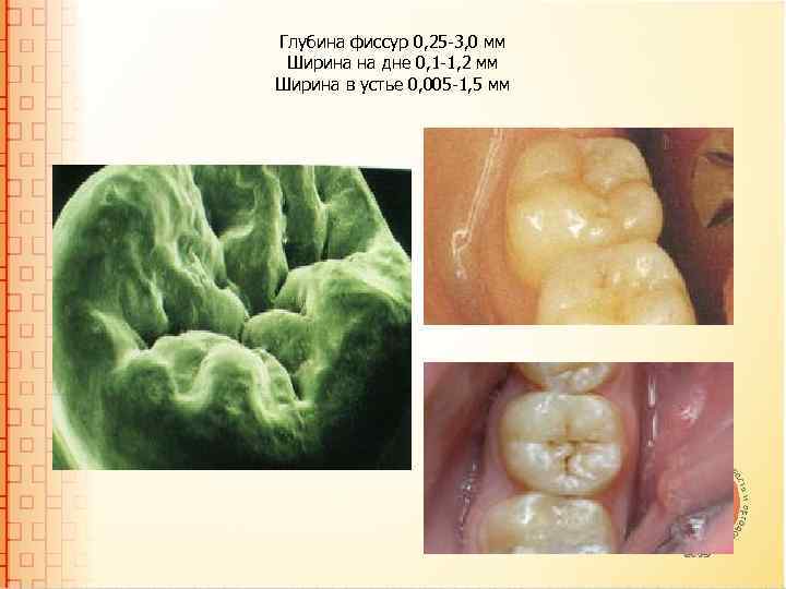 Глубина фиссур 0, 25 -3, 0 мм Ширина на дне 0, 1 -1, 2