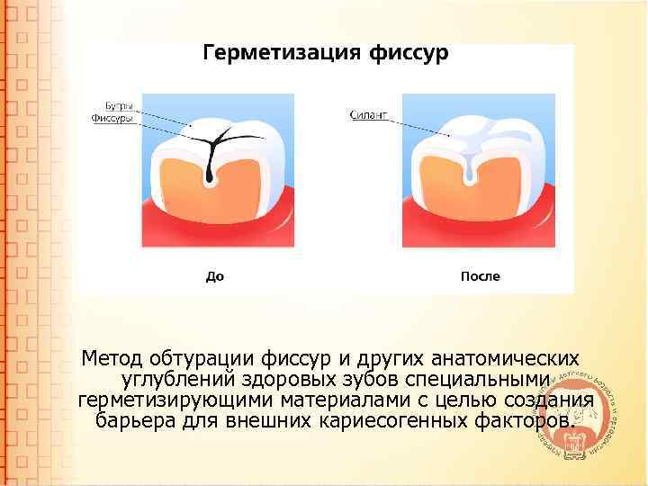 Инвазивный метод герметизации фиссур