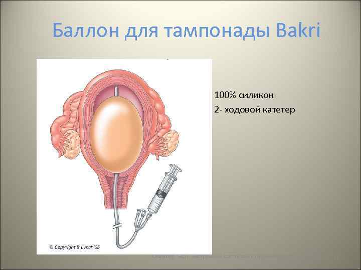 Баллонная тампонада матки презентация