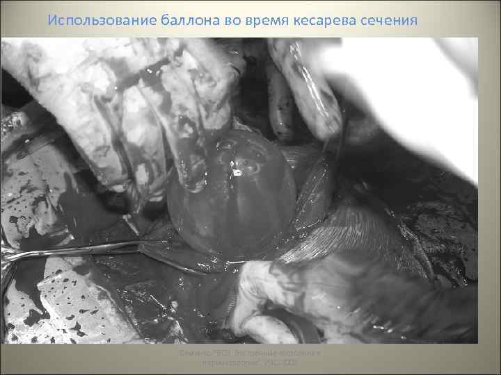 Использование баллона во время кесарева сечения Семинар 