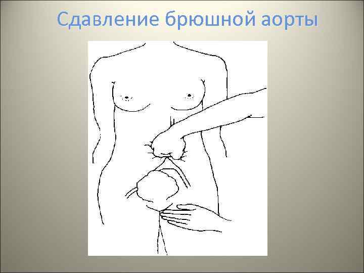 Сдавление брюшной аорты 