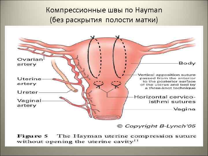 Компрессионные швы по Hayman (без раскрытия полости матки) 47 