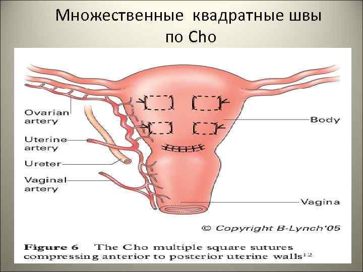 Множественные квадратные швы по Cho 49 