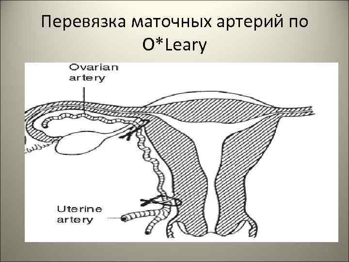 Перевязка маточных сосудов. Перевязка маточных артерий. Билатеральная перевязка маточных артерий. Перевязка восходящих ветвей маточных артерий. Перевязка маточно-яичниковых сосудов.