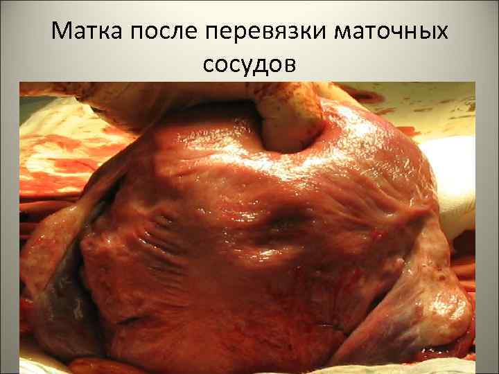 Матка после перевязки маточных сосудов 52 