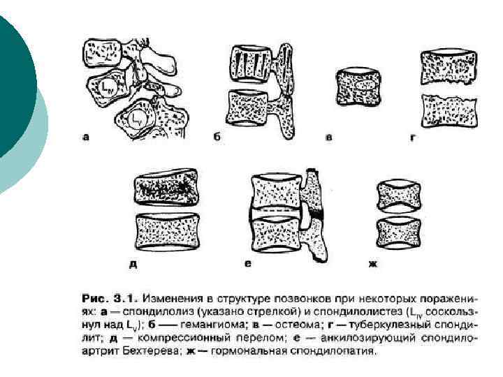 Дисгормональные переломы