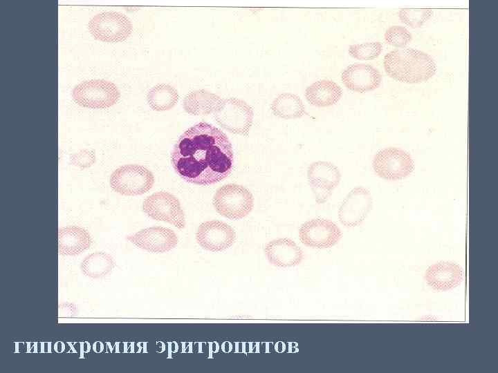 гипохромия эритроцитов 