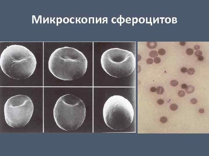 Микроскопия сфероцитов 