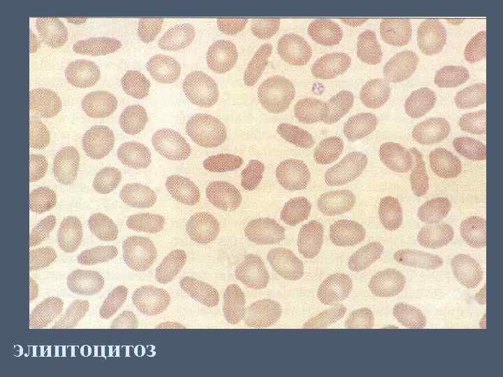 элиптоцитоз 